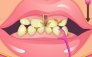 Whitening Sitzung Zähne